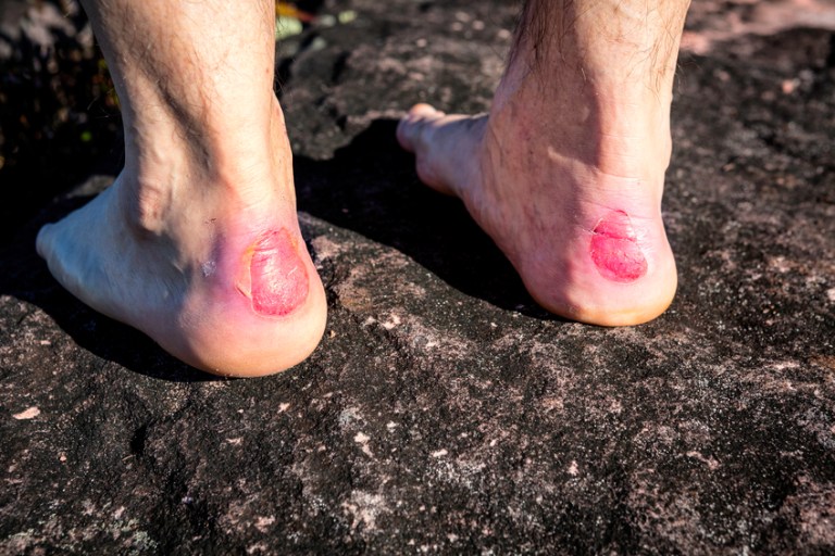 Cách chữa phồng rộp da chân khi đi trekking do mang giày chật