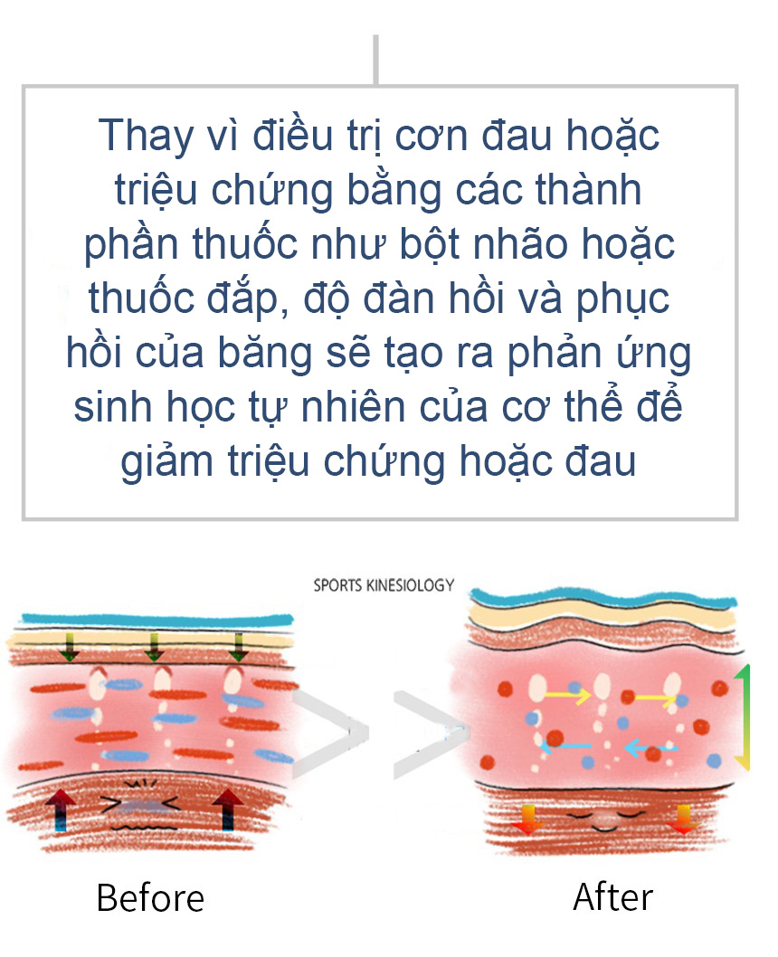 Băng dán cơ thể thao Insmedic Sports Kinesiology